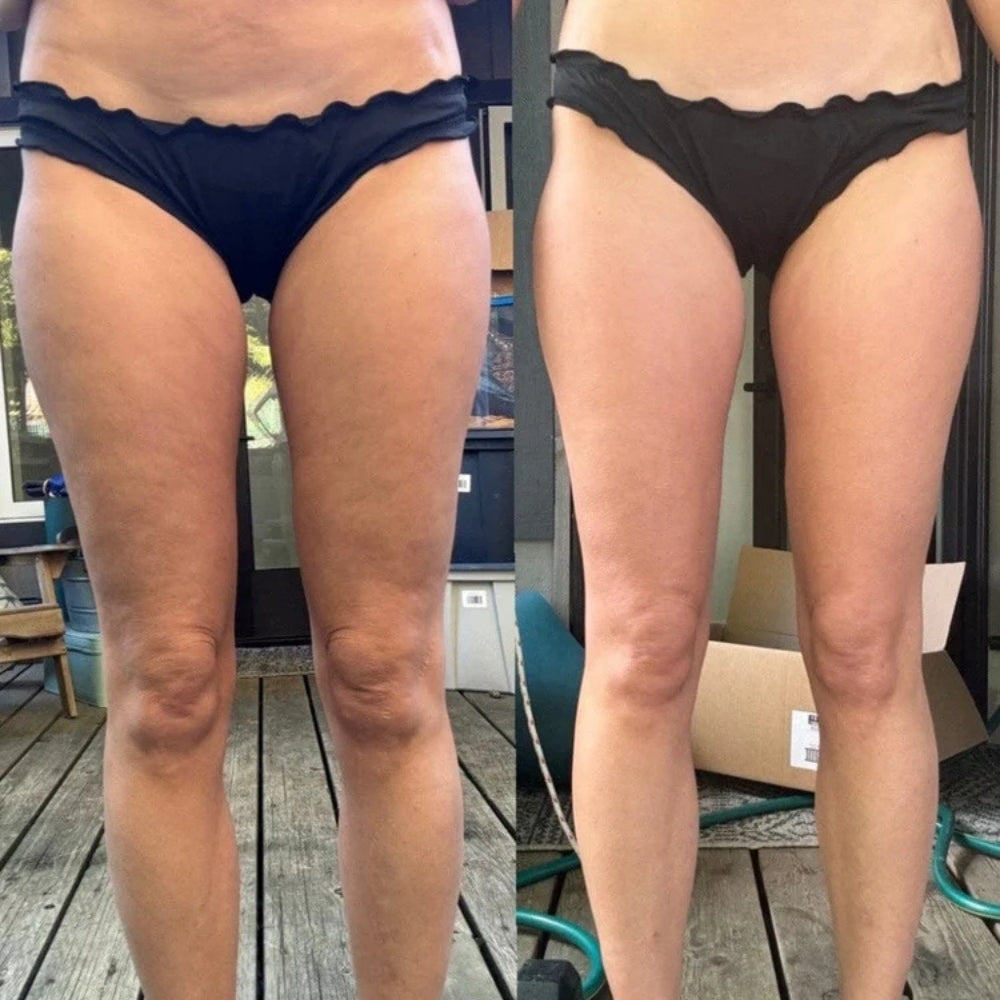 Fayletto™ - Anti-Cellulite Massager